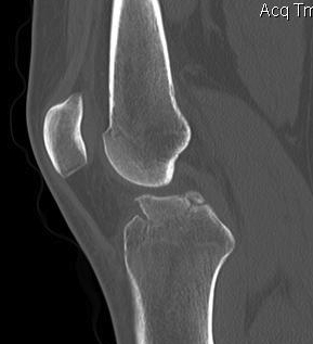 ACL Bony Avulsion CT